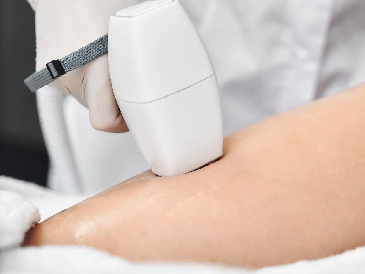 laser hair removal treatment on leg
