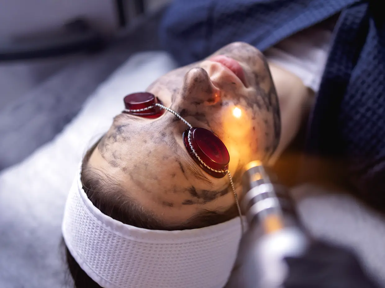 person receiving laser facial treatment with charcoal mask