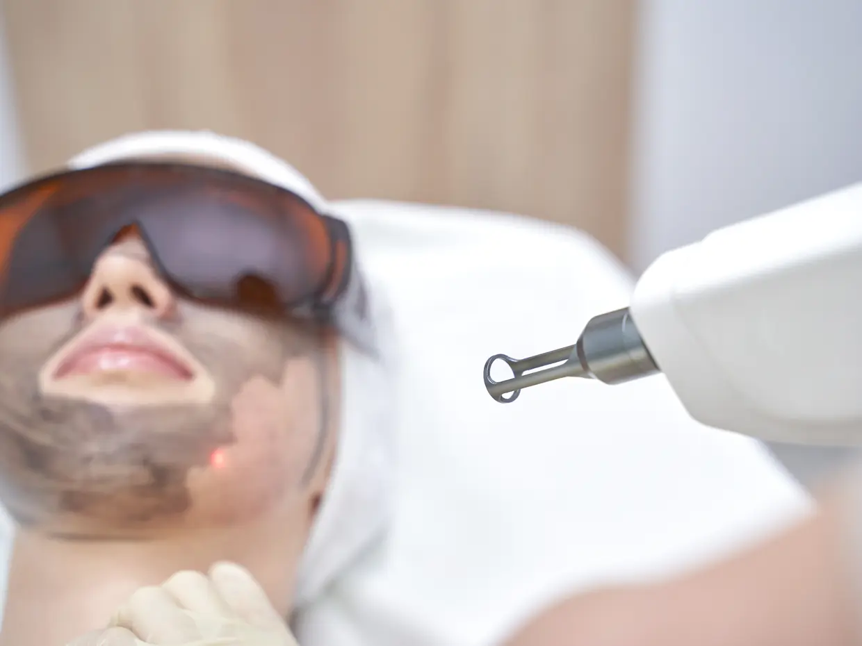 person receiving laser facial treatment with charcoal mask