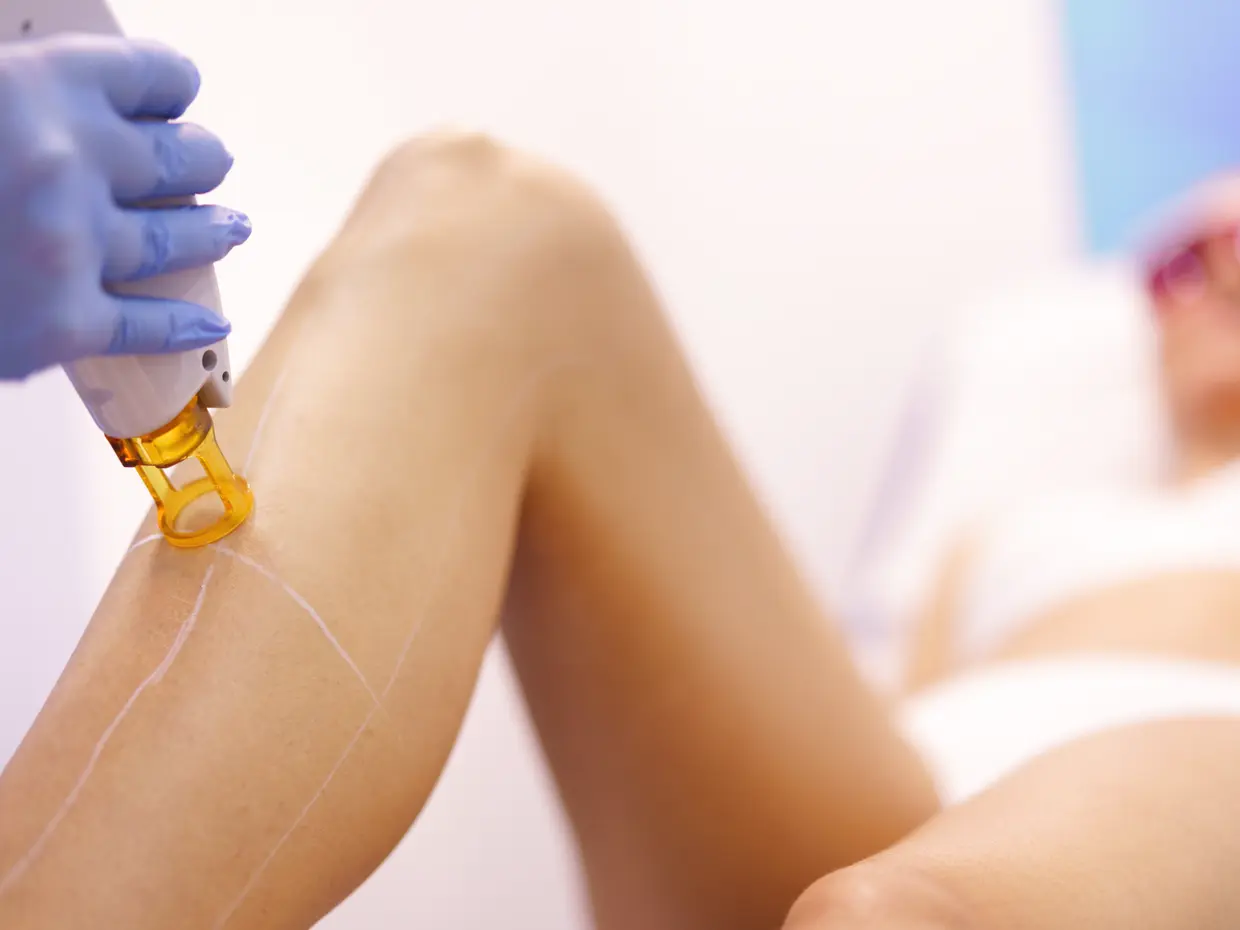 laser hair removal treatment on a leg