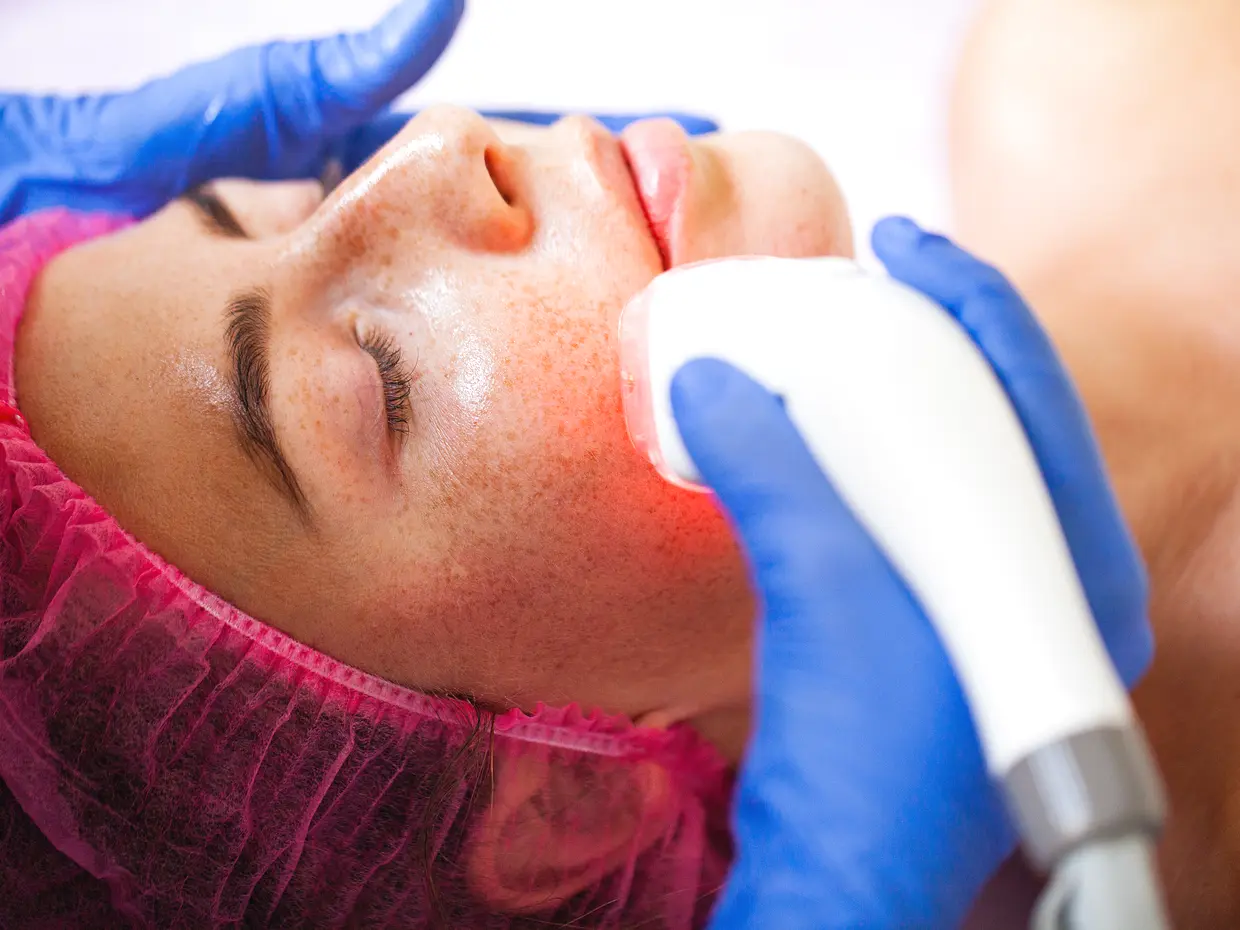 close-up of woman receiving facial laser treatment