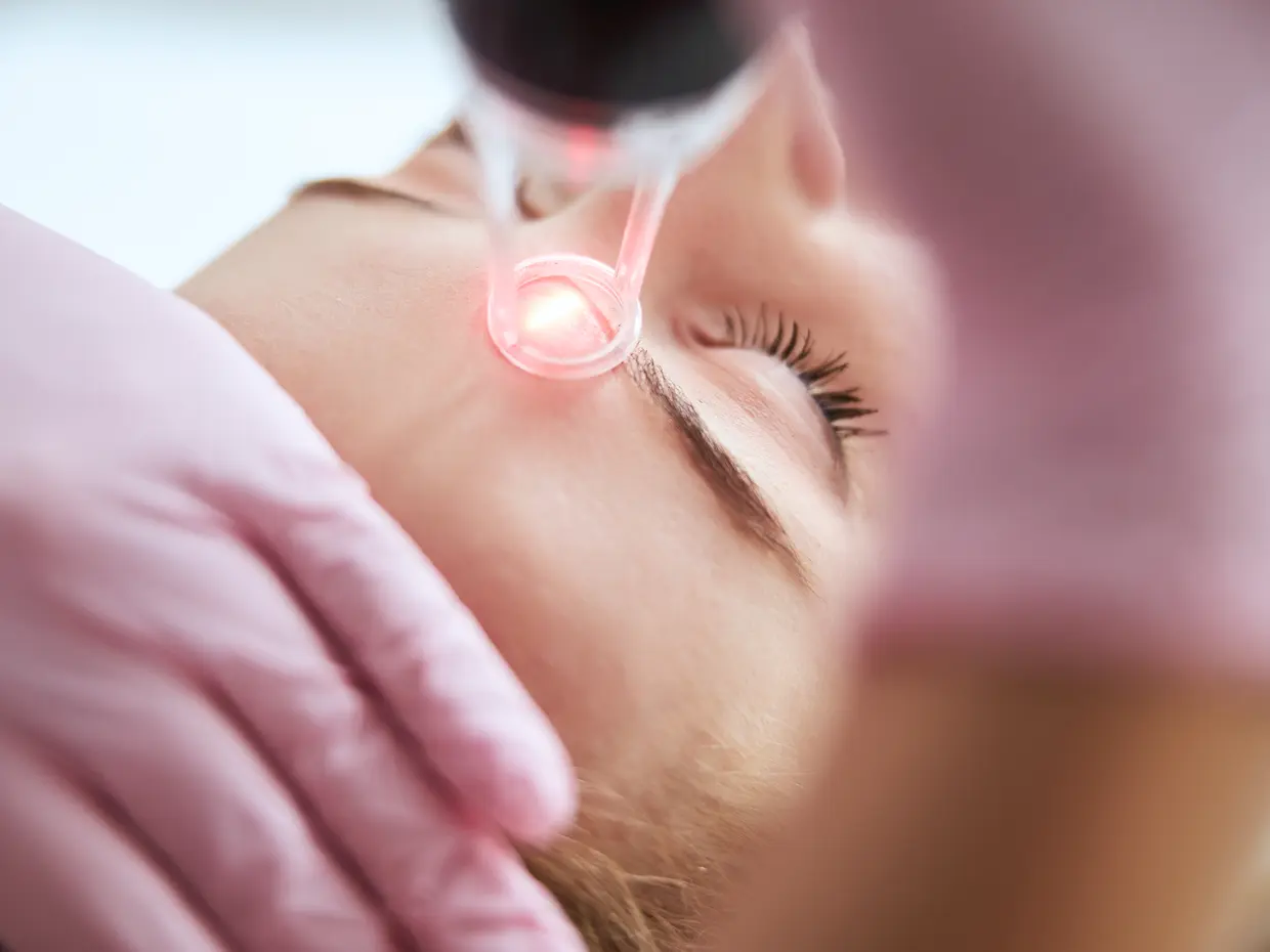 close up of woman receiving laser treatment on forehead