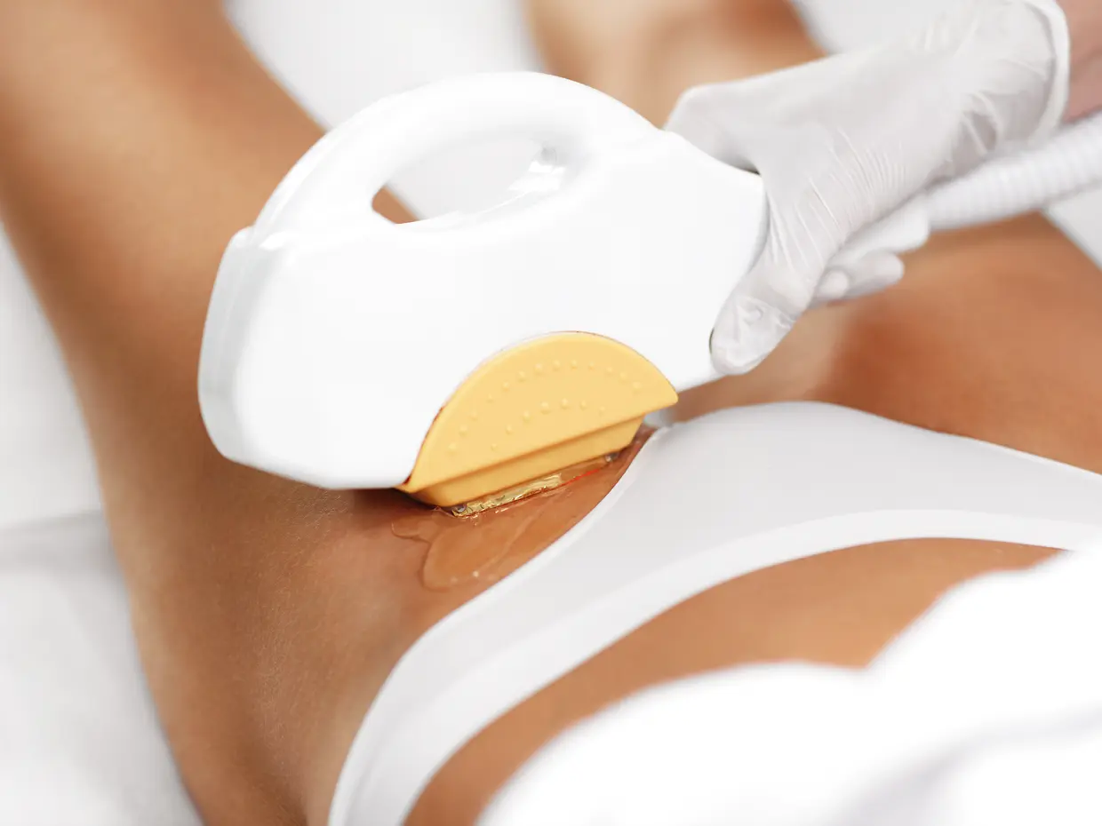 laser hair removal on bikini area