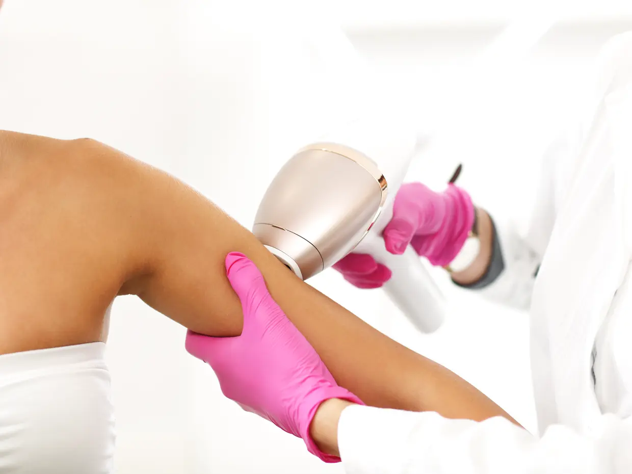 laser hair removal treatment on arm