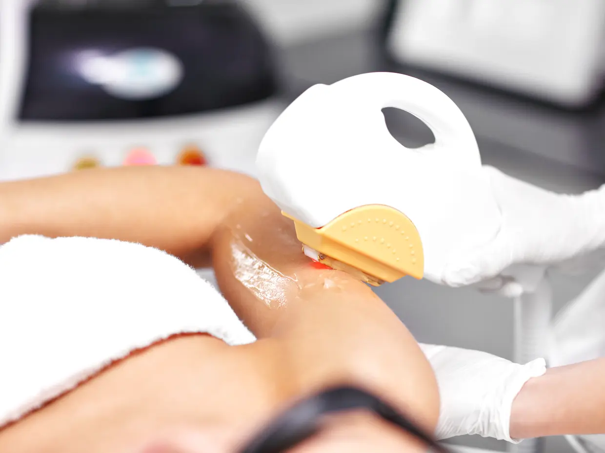 laser hair removal treatment on arm